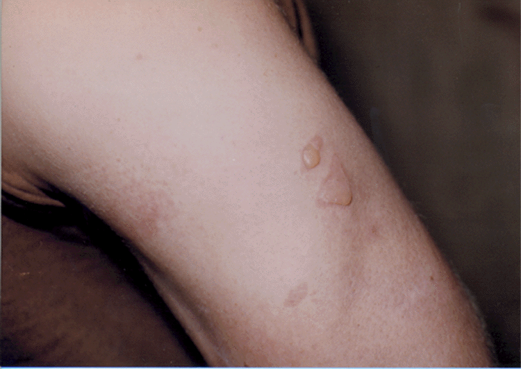 Figure 4.  Private Fisher blister injury - Dr. DeClue photo