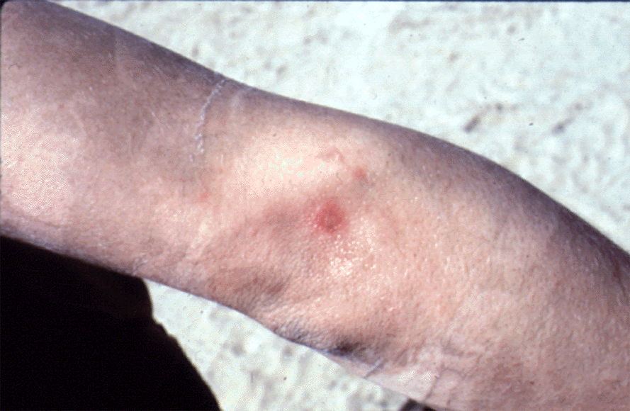 Figure 6.  Private Fisher blister injury - Dr. Dunn photo 2