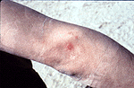 Figure 6.  Private Fisher blister injury - Dr. Dunn photo 2